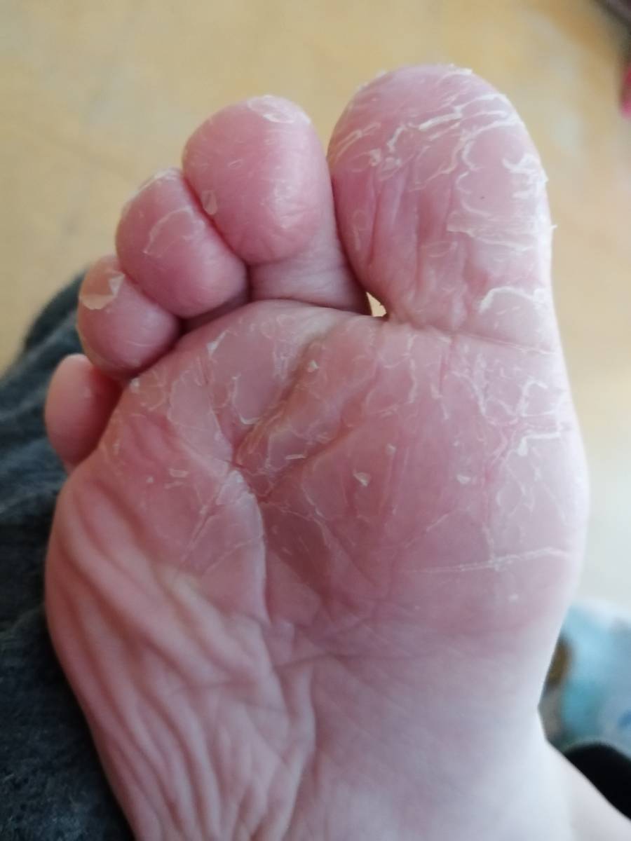 Jak casto koupat nohy v hypermanganu?