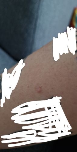 Boulicka/pupinek na ruce