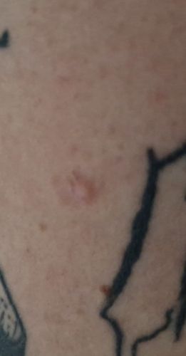 Boulicka/pupinek na ruce #2